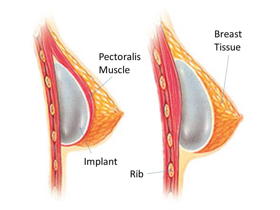 Breast Augmentation 101: Pocket Placement , Over or Under The